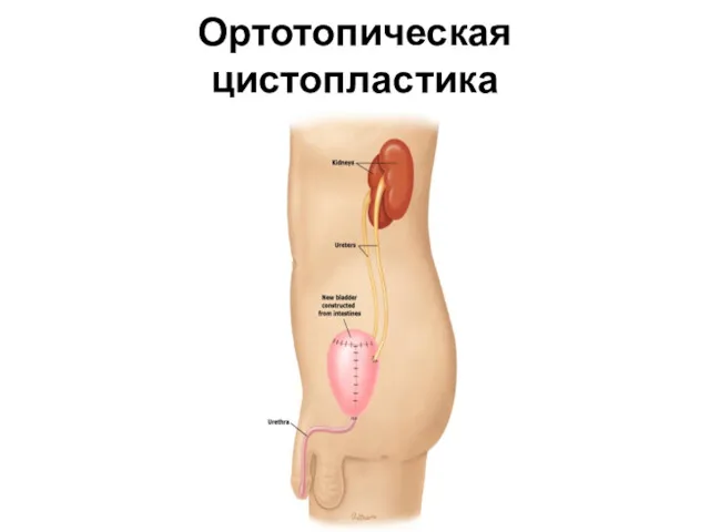 Ортотопическая цистопластика