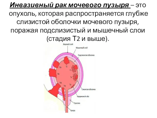 Инвазивный рак мочевого пузыря – это опухоль, которая распространяется глубже