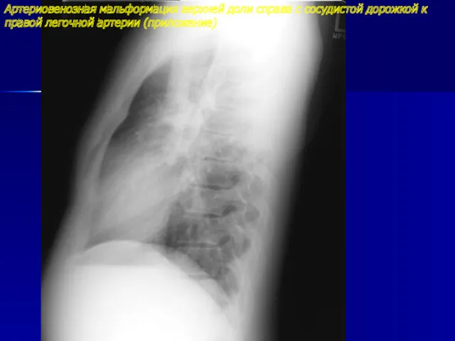 Артериовенозная мальформация верхней доли справа с сосудистой дорожкой к правой легочной артерии (приложение)
