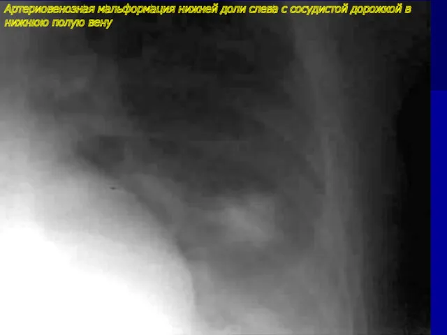 Артериовенозная мальформация нижней доли слева с сосудистой дорожкой в нижнюю полую вену