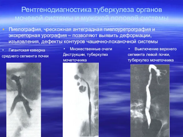 Рентгенодиагностика туберкулеза органов мочевой системы и мужской половой системы Пиелография, чрескожная антеградная пиелоуретрография