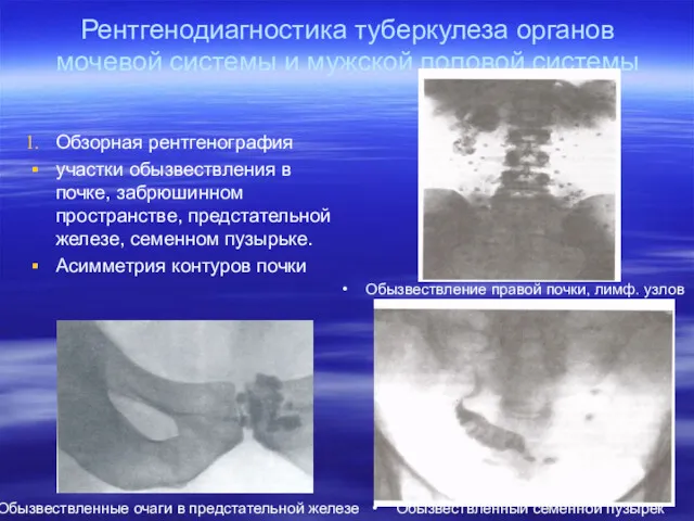 Рентгенодиагностика туберкулеза органов мочевой системы и мужской половой системы Обзорная рентгенография участки обызвествления
