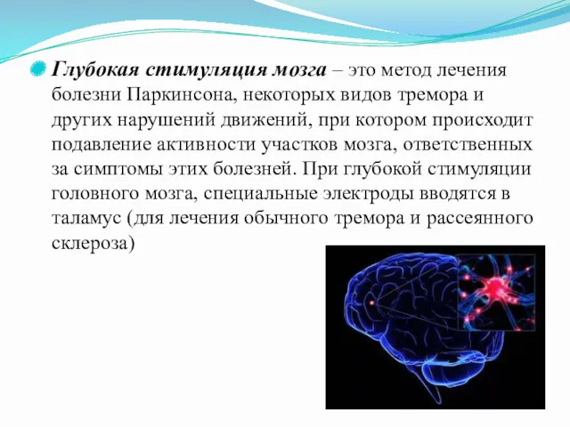 Глубокая стимуляция мозга – это метод лечения болезни Паркинсона, некоторых