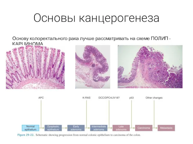 Основы канцерогенеза Основу колоректального рака лучше рассматривать на схеме ПОЛИП - КАРЦИНОМА