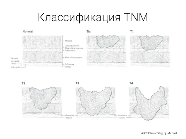 Классификация TNM AJCC Cáncer Staging Manual