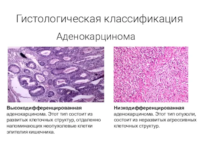 Гистологическая классификация Аденокарцинома Высокодифференцированная аденокарцинома. Этот тип состоит из развитых