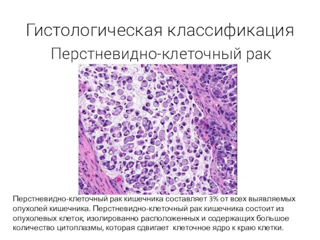 Гистологическая классификация Перстневидно-клеточный рак Перстневидно-клеточный рак кишечника составляет 3% от