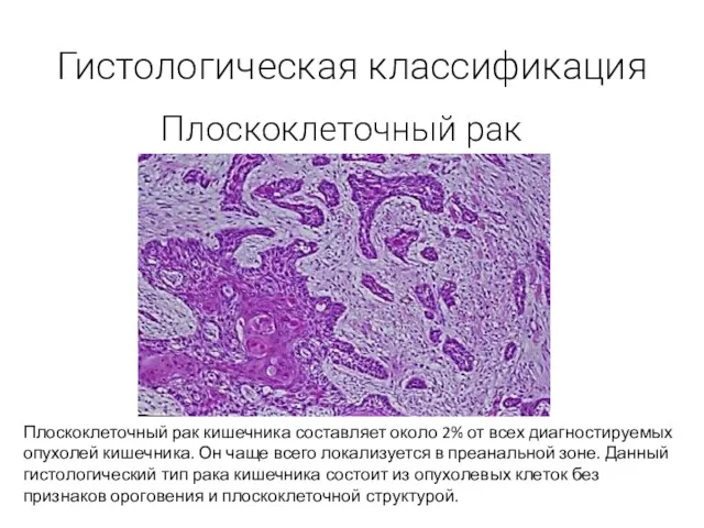 Гистологическая классификация Плоскоклеточный рак Плоскоклеточный рак кишечника составляет около 2%