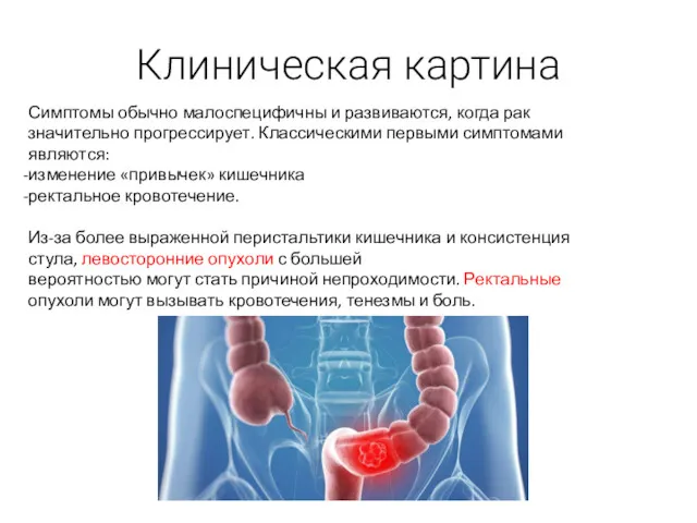 Клиническая картина Симптомы обычно малоспецифичны и развиваются, когда рак значительно