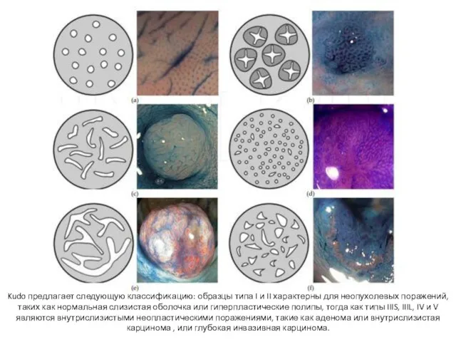 Kudo предлагает следующую классификацию: образцы типа I и II характерны
