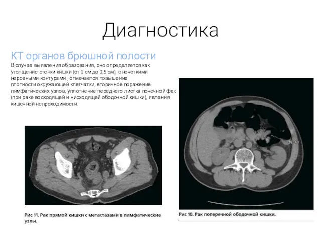 Диагностика КТ органов брюшной полости В случае выявления образования, оно