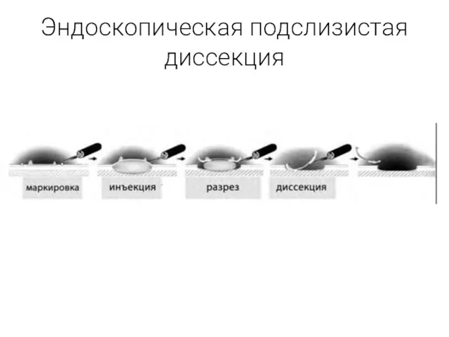 Эндоскопическая подслизистая диссекция