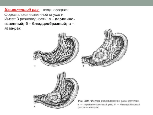Изъявленный рак - неоднородная форма злокачественной опухоли. Имеет 3 разновидности: