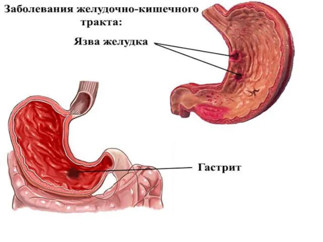 Язвенная болезнь – это хроническая болезнь, протекающая с формированием язвенных