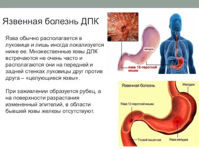 Язвенная болезнь ДПК Язва обычно располагается в луковице и лишь