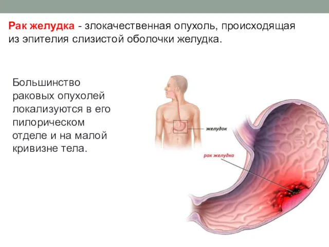 Рак желудка - злокачественная опухоль, происходящая из эпителия слизистой оболочки