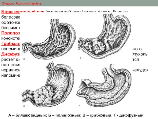 Бляшковидный рак («маленький рак») имеет форму бляшки белесоватого цвета, располагается