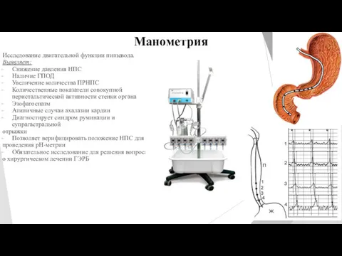 Манометрия Исследование двигательной функции пищевода. Выявляет: Снижение давления НПС Наличие