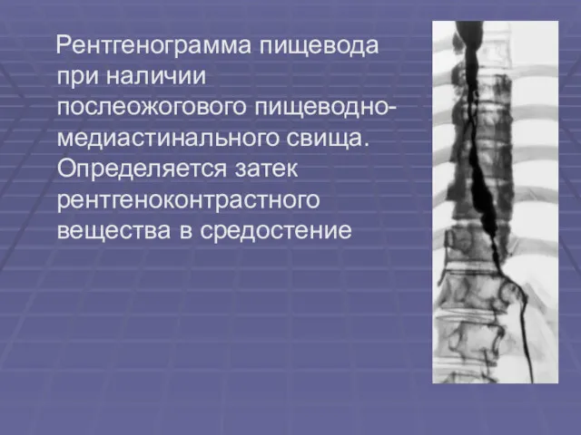 Рентгенограмма пищевода при наличии послеожогового пищеводно-медиастинального свища. Определяется затек рентгеноконтрастного вещества в средостение
