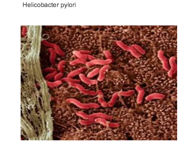 Helicobacter pylori