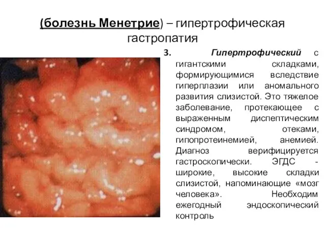 (болезнь Менетрие) – гипертрофическая гастропатия 3. Гипертрофический с гигантскими складками,