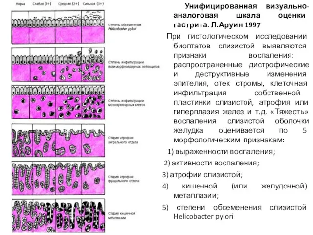 Унифицированная визуально-аналоговая шкала оценки гастрита. Л.Аруин 1997 При гистологическом исследовании