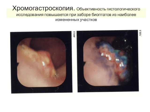Хромогастроскопия. Объективность гистологического исследования повышается при заборе биоптатов из наиболее измененных участков