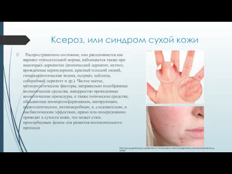 Ксероз, или синдром сухой кожи Распространенное состояние, оно расценивается как вариант относительной нормы,