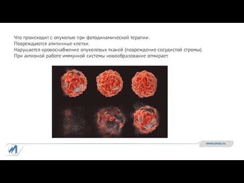 Что происходит с опухолью при фотодинамической терапии: Повреждаются атипичные клетки.