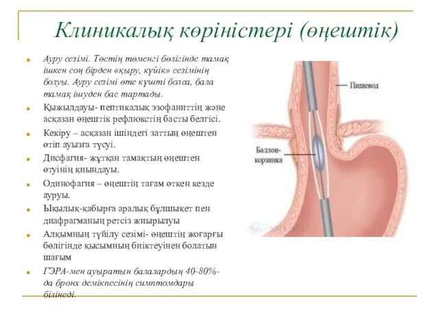 Клиникалық көріністері (өңештік) Ауру сезімі. Төстің төменгі бөлігінде тамақ ішкен