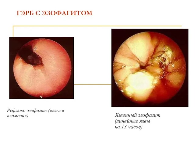 ГЭРБ С ЭЗОФАГИТОМ Рефлюкс-эзофагит («языки пламени») Язвенный эзофагит (линейные язвы на 13 часов)