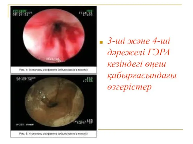 3-ші және 4-ші дәрежелі ГЭРА кезіндегі өңеш қабырғасындағы өзгерістер