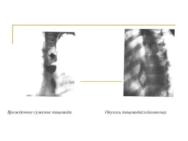 Врожденное сужение пищевода Опухоль пищевода(лейомиома)