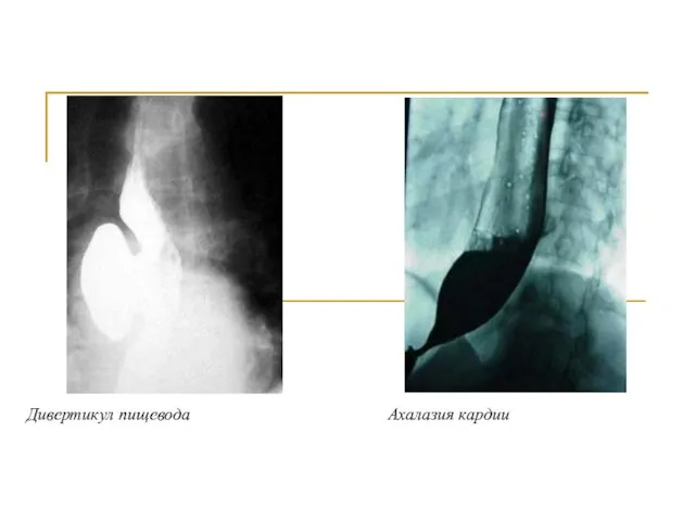 Дивертикул пищевода Ахалазия кардии