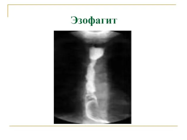 Эзофагит