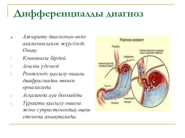 Дифференциалды диагноз Ажырату диагнозын өкпе ахалазиясымен жүргізеді. Оның: Клиникасы бірдей