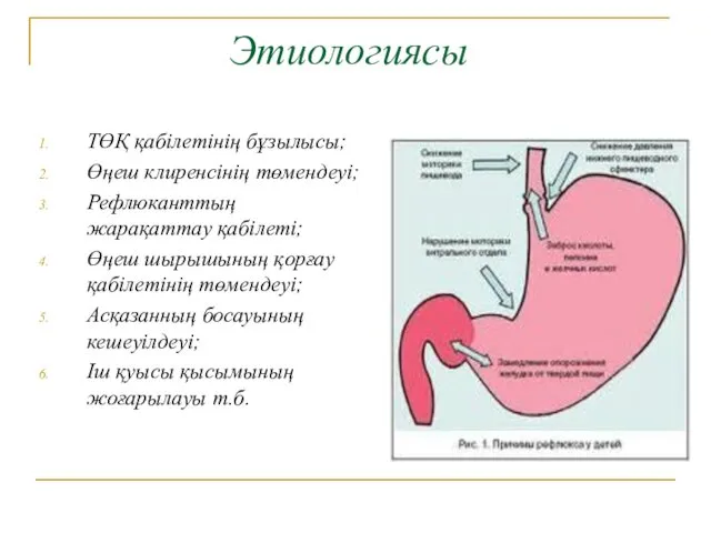 Этиологиясы ТӨҚ қабілетінің бұзылысы; Өңеш клиренсінің төмендеуі; Рефлюканттың жарақаттау қабілеті;