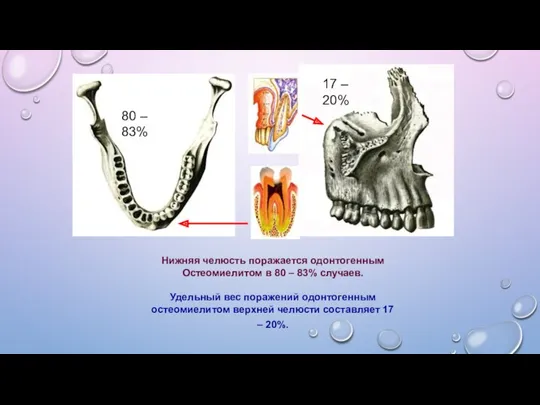 Нижняя челюсть поражается одонтогенным Остеомиелитом в 80 – 83% случаев.