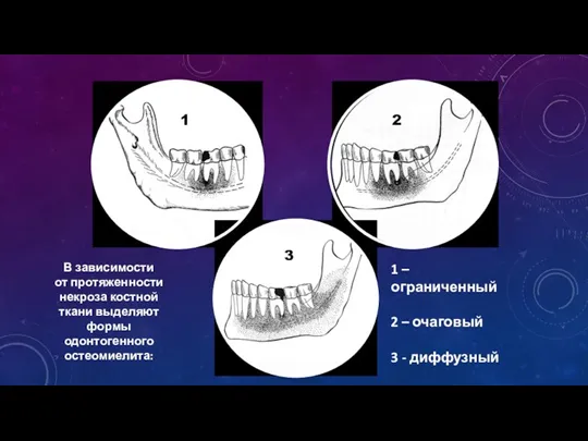 1 – ограниченный 2 – очаговый 3 - диффузный В