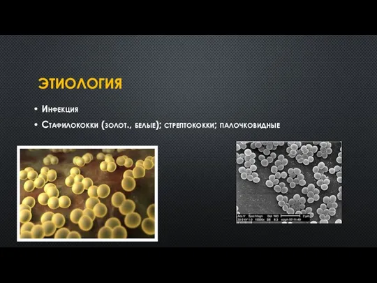 ЭТИОЛОГИЯ Инфекция Стафилококки (золот., белые); стрептококки; палочковидные