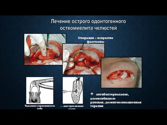 Лечение острого одонтогенного остеомиелита челюстей Операция – вскрытие флегмоны Удаление