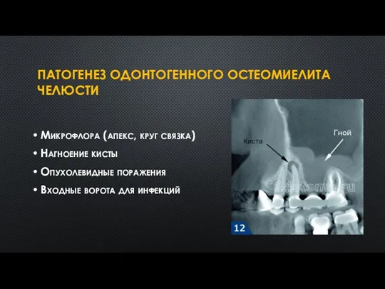 ПАТОГЕНЕЗ ОДОНТОГЕННОГО ОСТЕОМИЕЛИТА ЧЕЛЮСТИ Микрофлора (апекс, круг связка) Нагноение кисты Опухолевидные поражения Входные ворота для инфекций