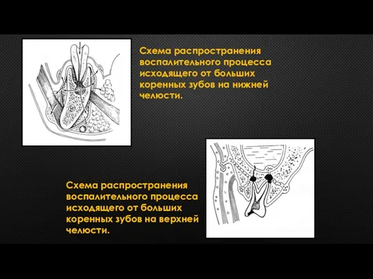 Схема распространения воспалительного процесса исходящего от больших коренных зубов на