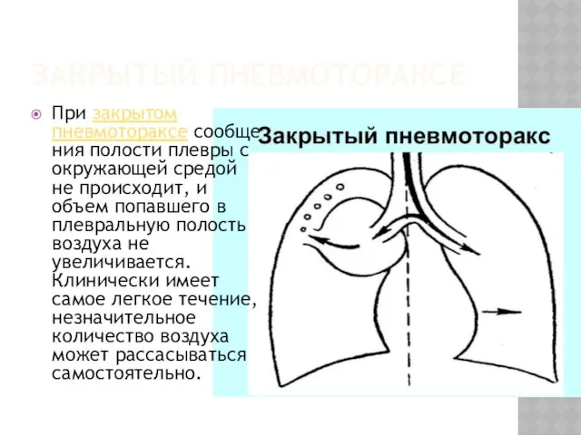 ЗАКРЫТЫЙ ПНЕВМОТОРАКСЕ При закрытом пневмотораксе сообщения полости плевры с окружающей