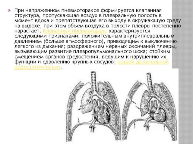 При напряженном пневмотораксе формируется клапанная структура, пропускающая воздух в плевральную