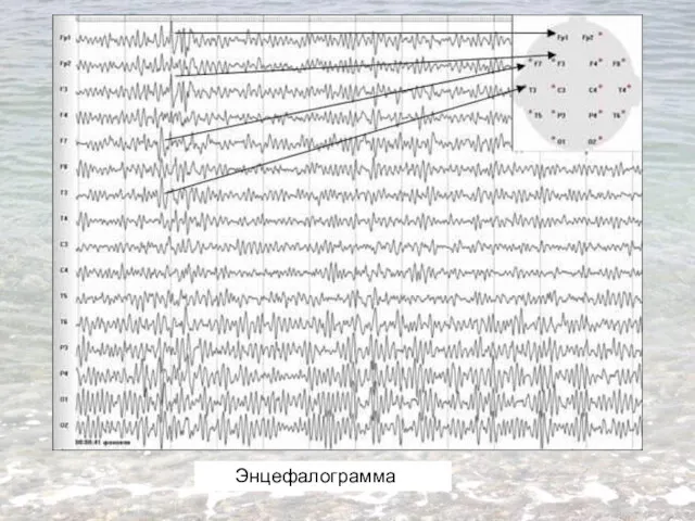 Энцефалограмма