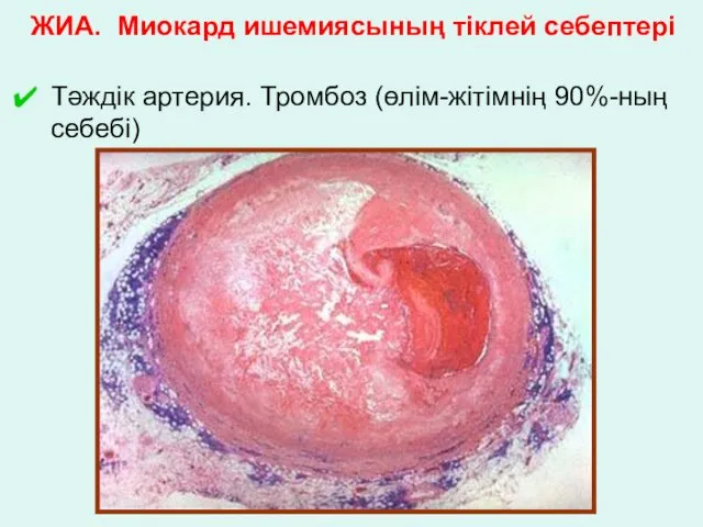 ЖИА. Миокард ишемиясының тіклей себептері Тәждік артерия. Тромбоз (өлім-жітімнің 90%-ның себебі)
