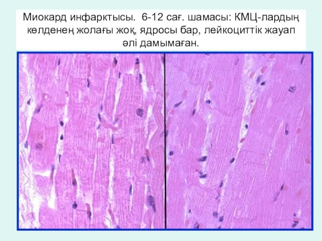 Миокард инфарктысы. 6-12 сағ. шамасы: КМЦ-лардың көлденең жолағы жоқ, ядросы бар, лейкоциттік жауап әлі дамымаған.