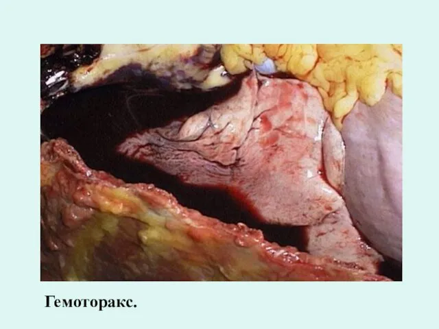 Гемоторакс.
