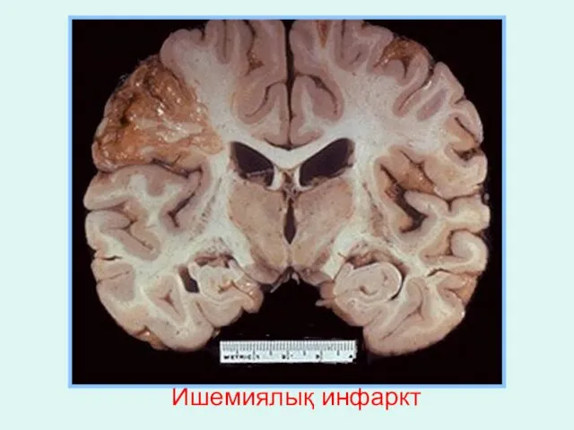 Ишемиялық инфаркт